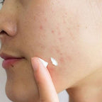 SKIN1004 – Crema para imperfecciones de uso localizado 20 ml